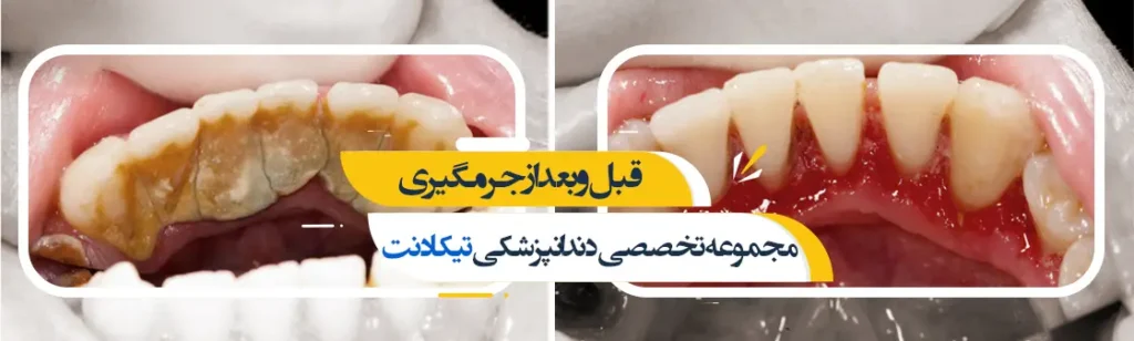 جرمگیری تیکادنت