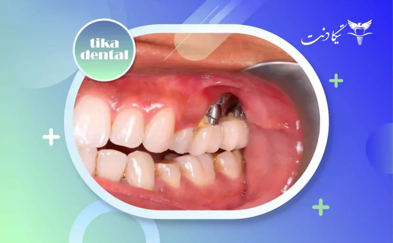 علائم پس زدن ایمپلنت