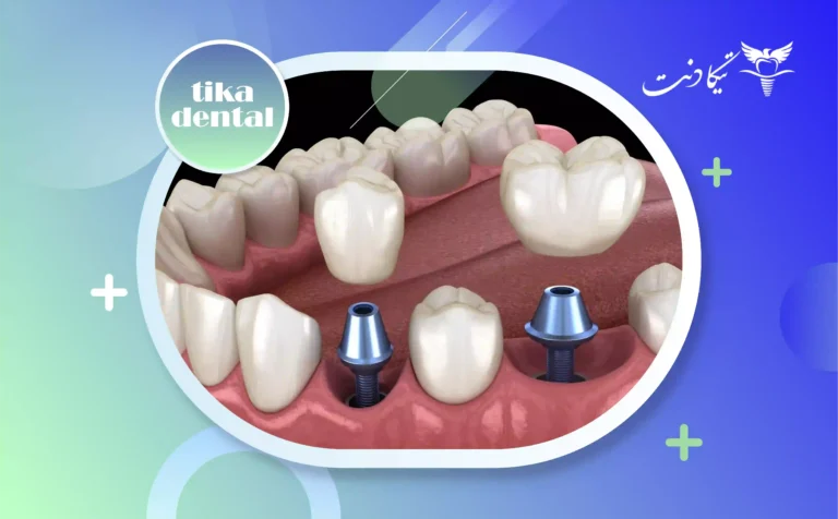 اباتمنت ایمپلنت