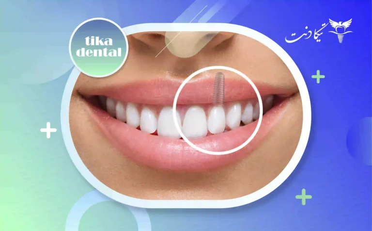 طول عمر ایمپلنت دندان
