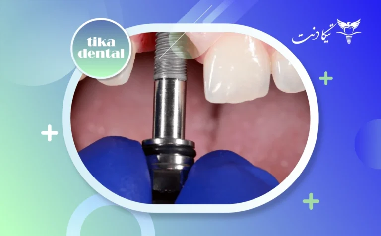 علت افتادن پیچ ایمپلنت دندان