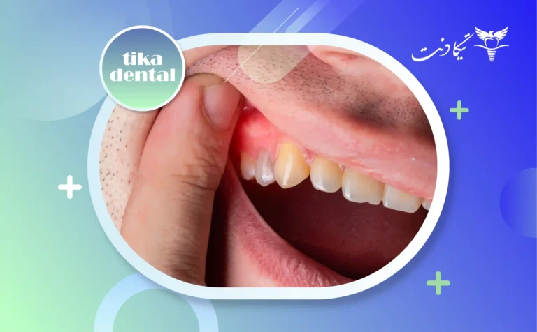 علت عفونت ایمپلنت دندان