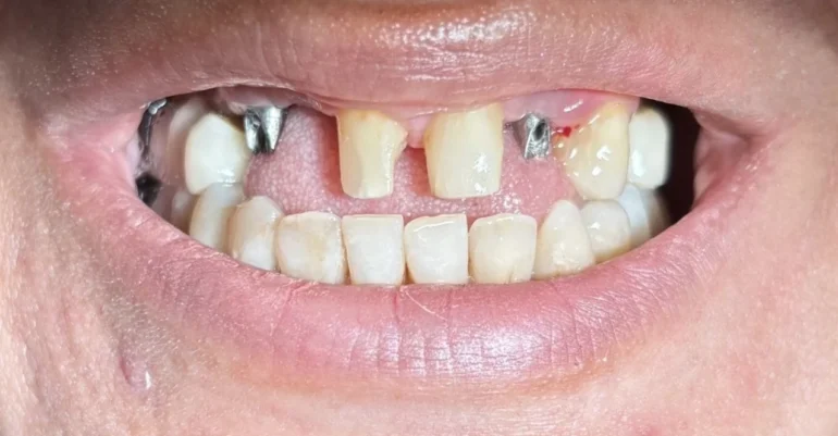 ایمپلنت اقساطی در تهران