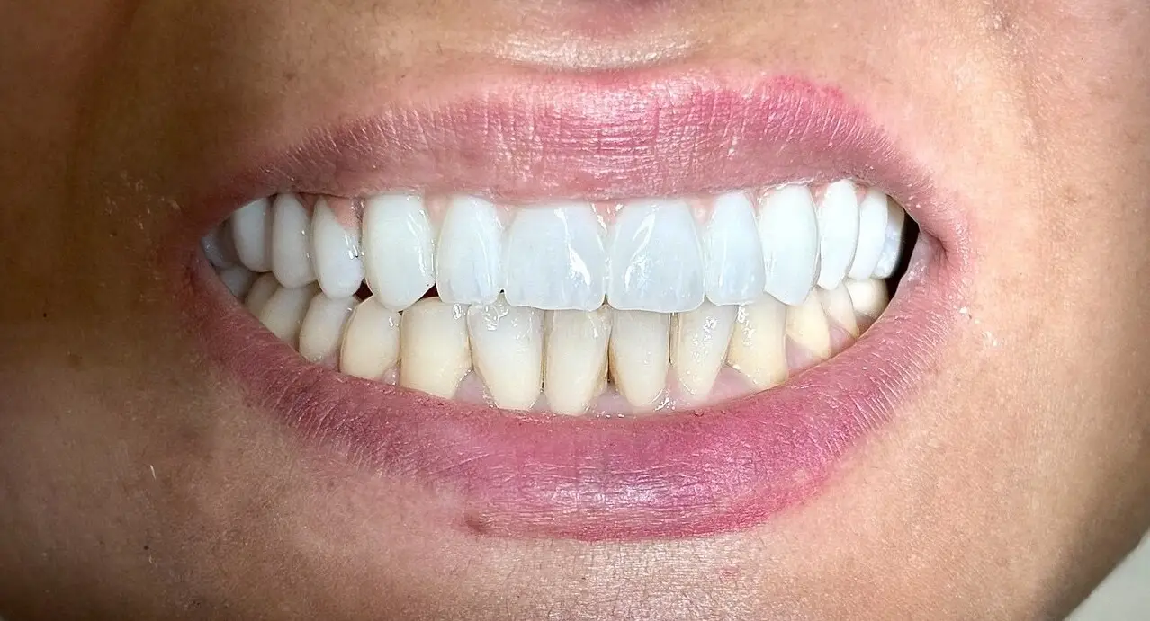 ایمپلنت دندان قسطی