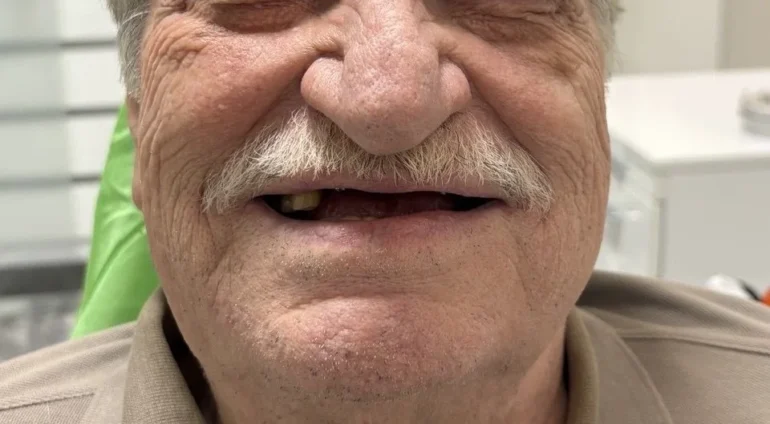 ایمپلنت فوری دندان