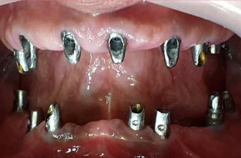 ایمپلنت فوری دندان در تهران