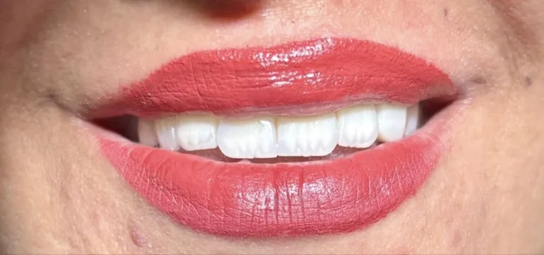 ایمپلنت قسطی در تهران