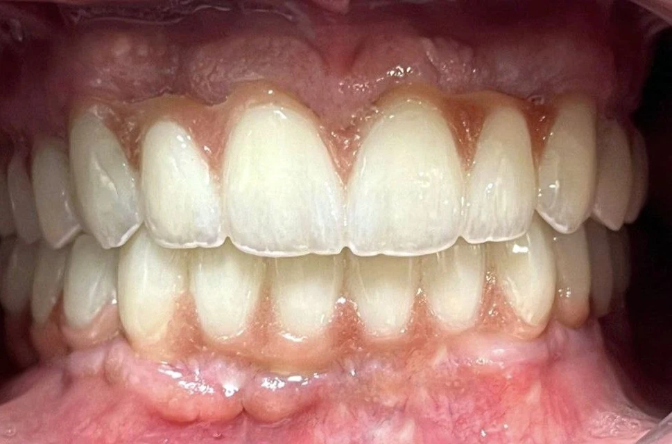 ایمپلنت یک روزه در تهران