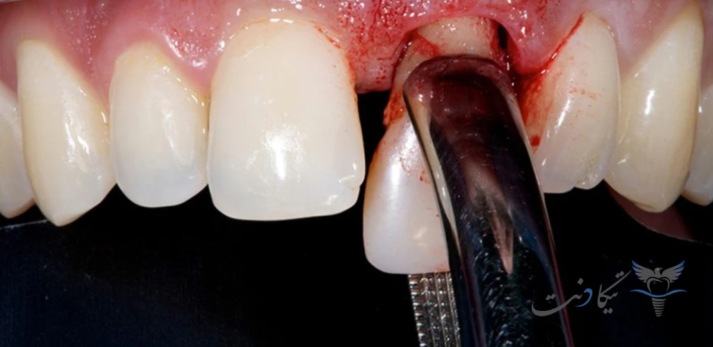 بهترین زمان ایمپلنت بعد از کشیدن دندان