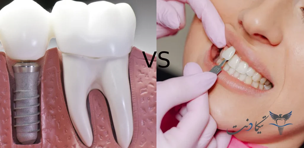 تفاوت ایمپلنت و کامپوزیت