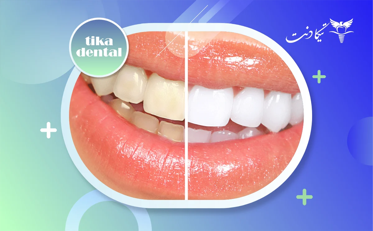 تفاوت بلیچینگ و جرم گیری دندان