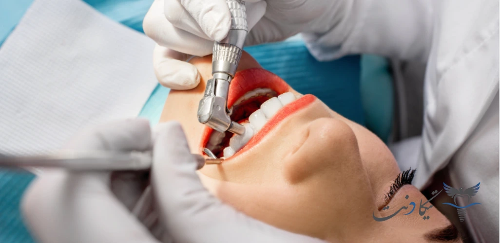 تفاوت جرم گیری با بلیچینگ