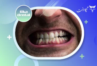 دندان قروچه چیست