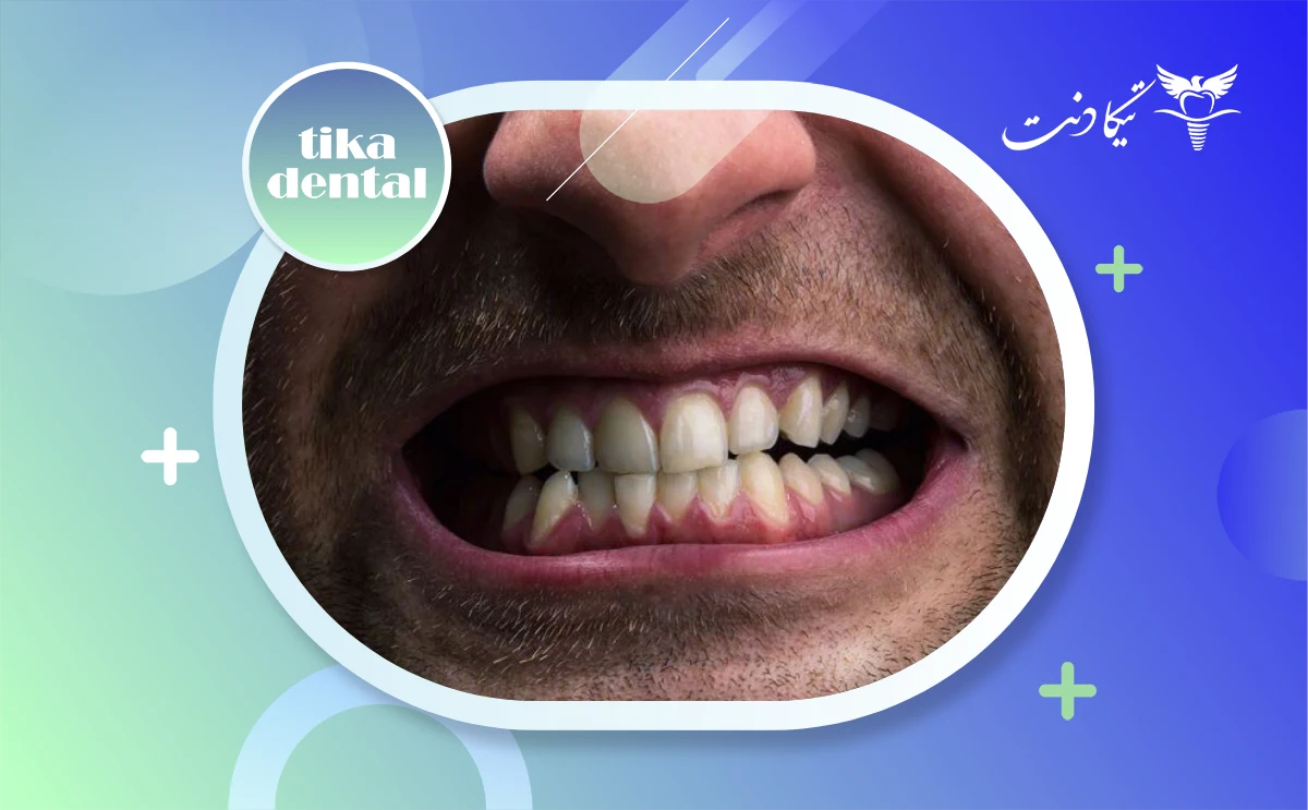 دندان قروچه چیست