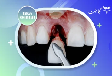 زمان ایمپلنت بعد از کشیدن دندان