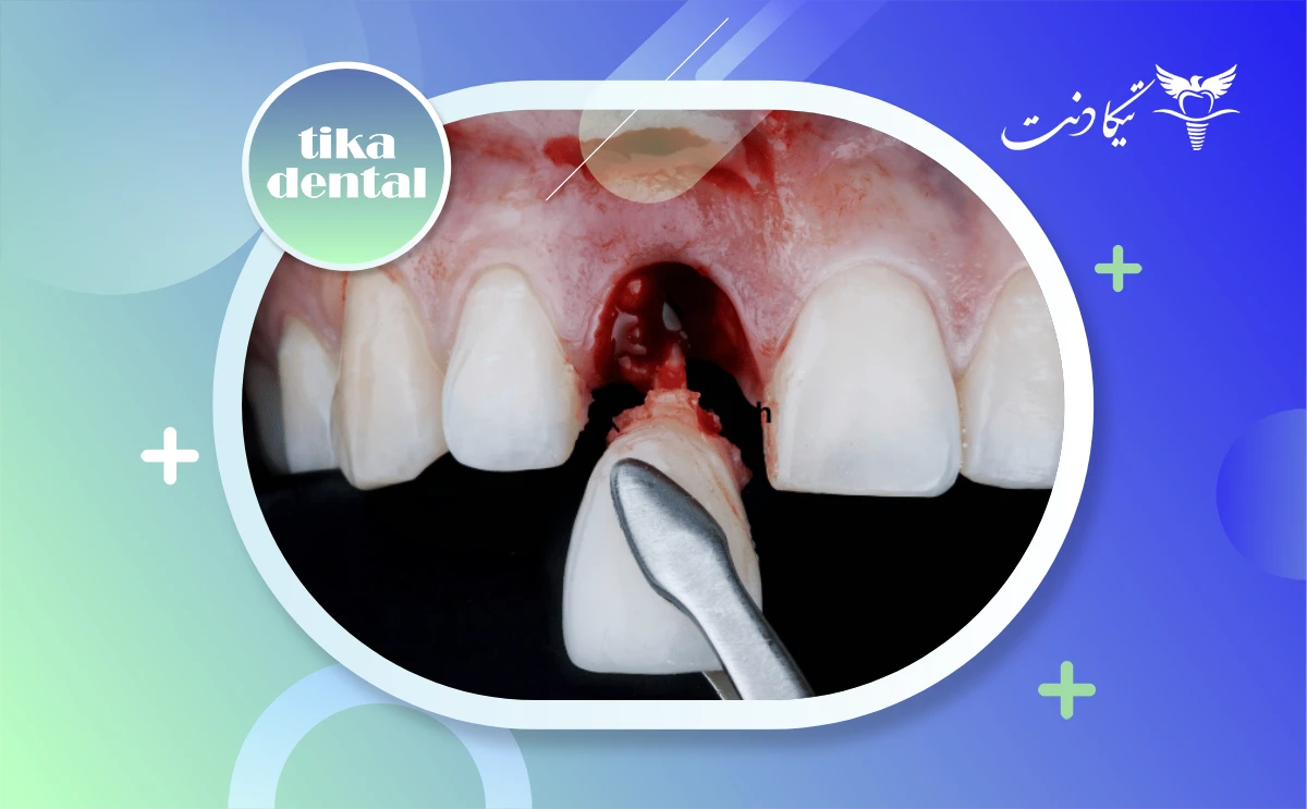 زمان ایمپلنت بعد از کشیدن دندان