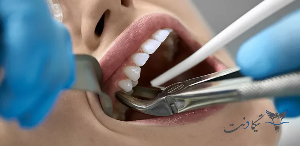 فاصله زمانی کشیدن دندان و ایمپلنت