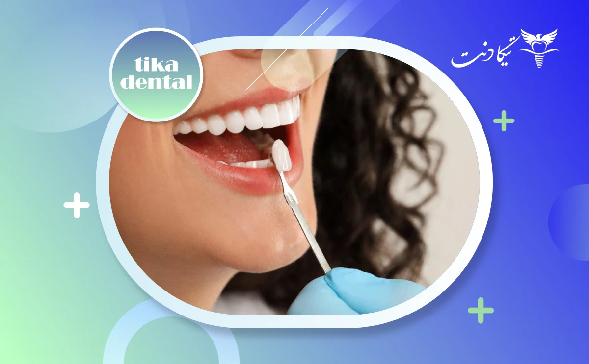 فرق ایمپلنت با کامپوزیت دندان
