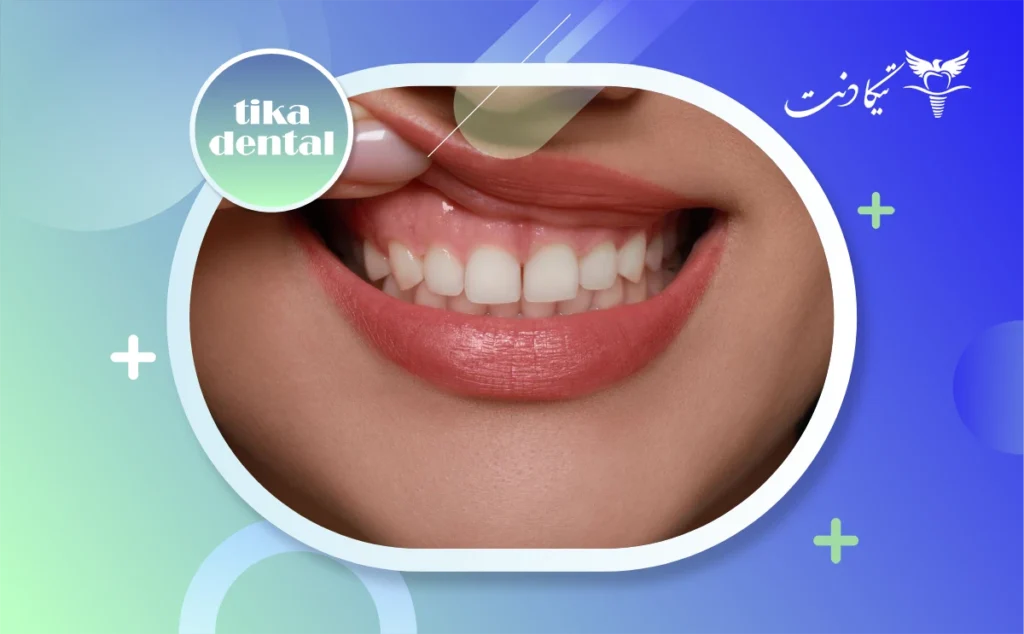 لیفت لثه برای کامپوزیت
