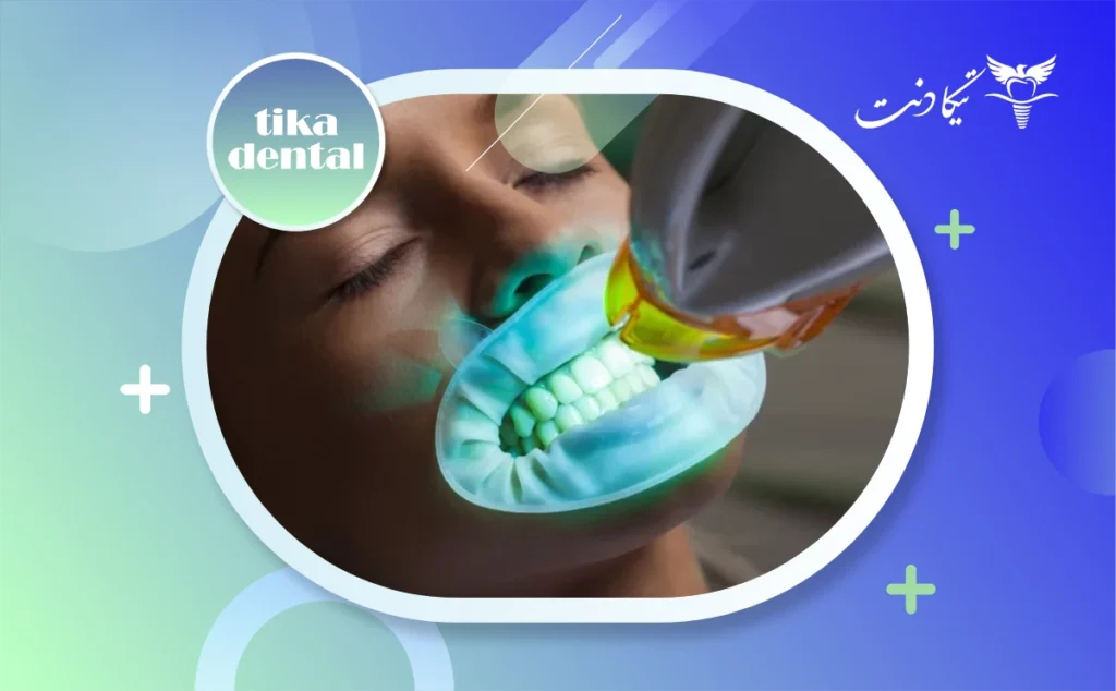 ماندگاری بلیچینگ دندان