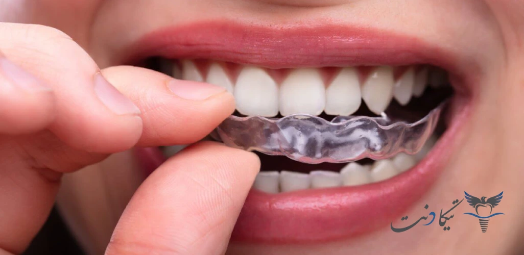 کنترل دندان قروچه در خواب