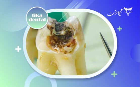 پوسیدگی دندان زیر کامپوزیت