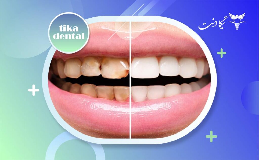 تفاوت لمینت و کامپوزیت
