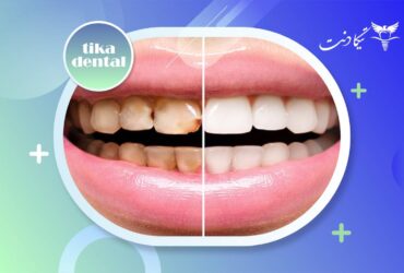 تفاوت لمینت و کامپوزیت