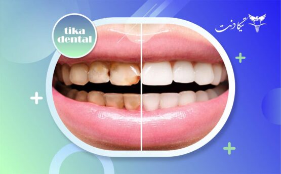 تفاوت لمینت و کامپوزیت