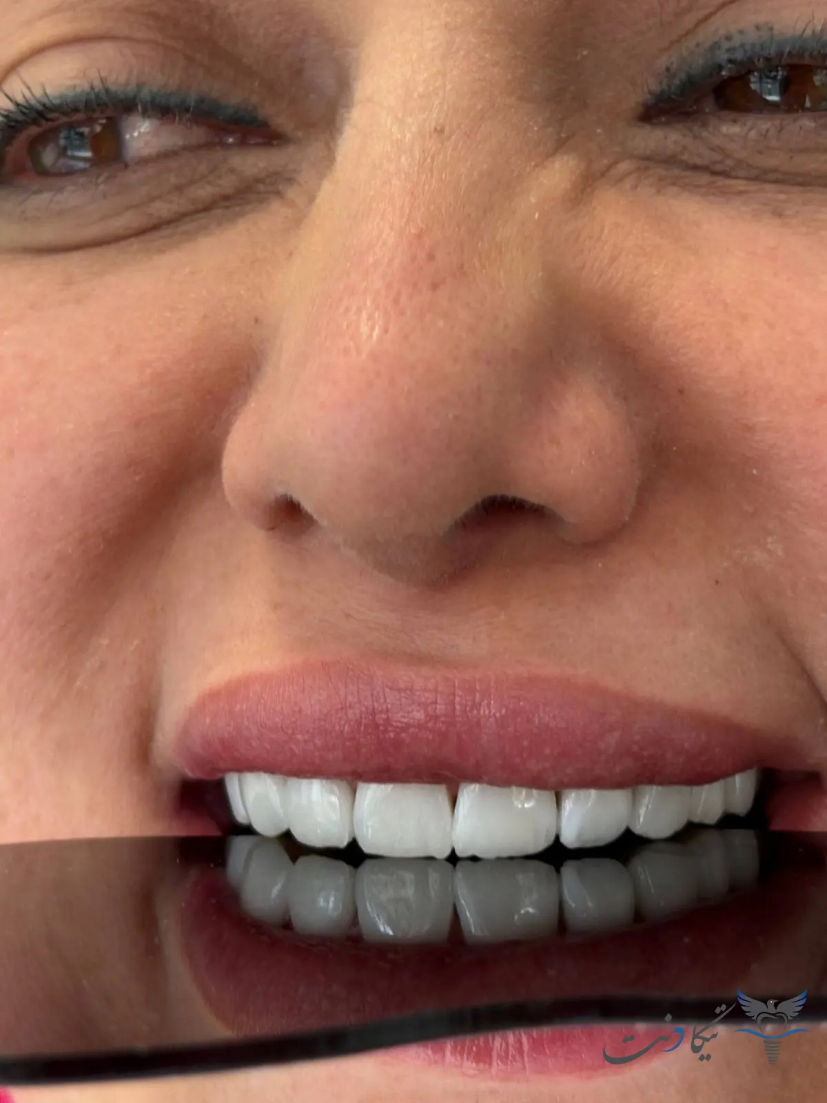 قیمت کامپوزیت سرامیکی