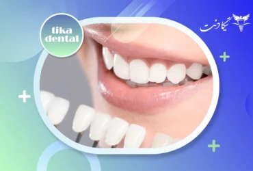 مراقبت های بعد از کامپوزیت دندان