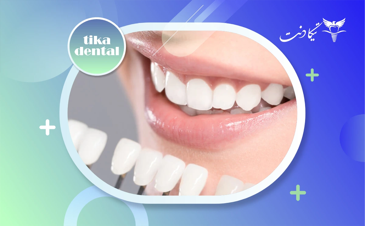 مراقبت های بعد از کامپوزیت دندان