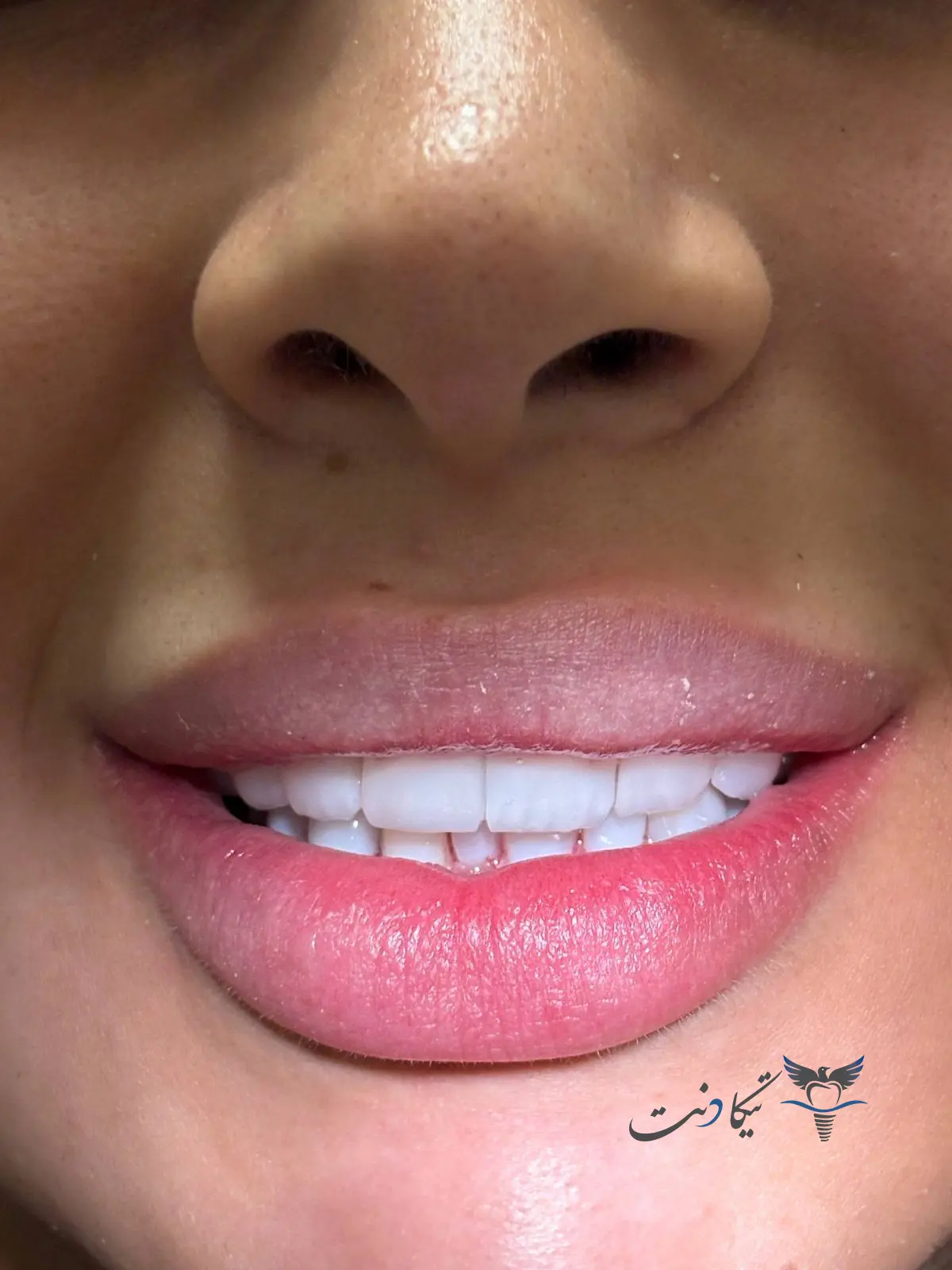 کامپوزیت ips