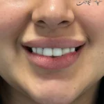 کامپوزیت آی پی اس