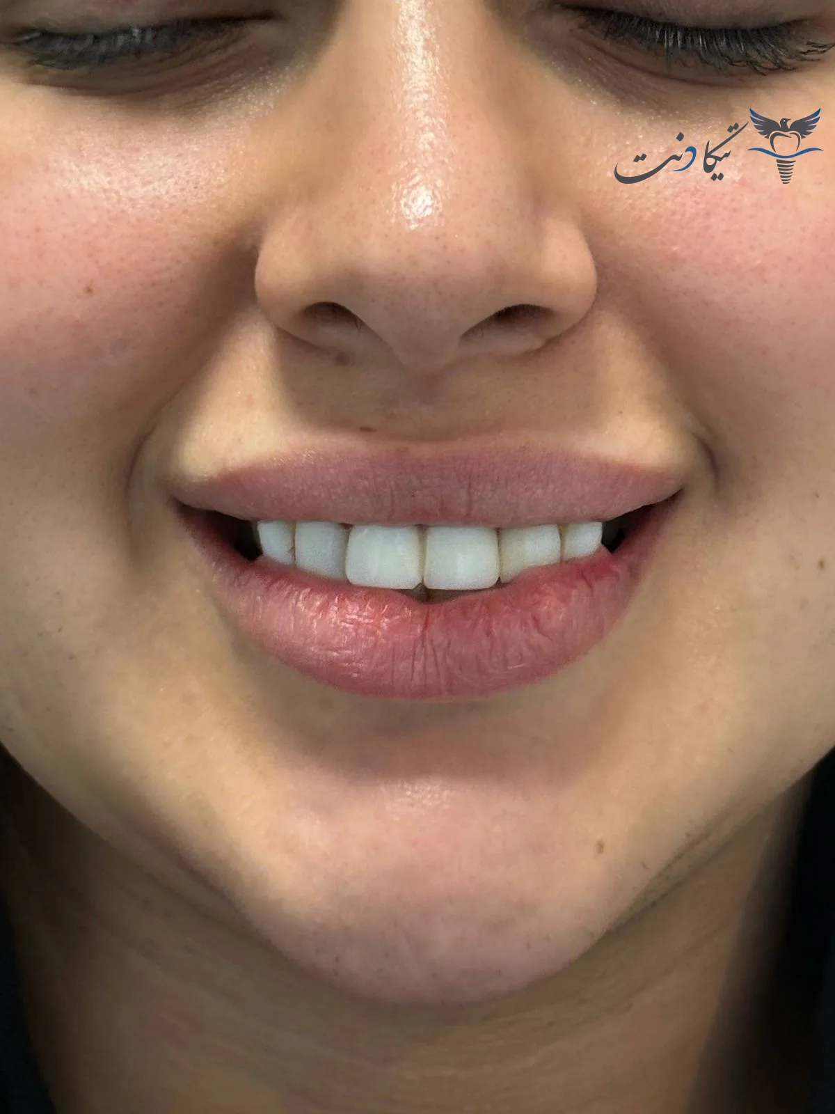 کامپوزیت آی پی اس