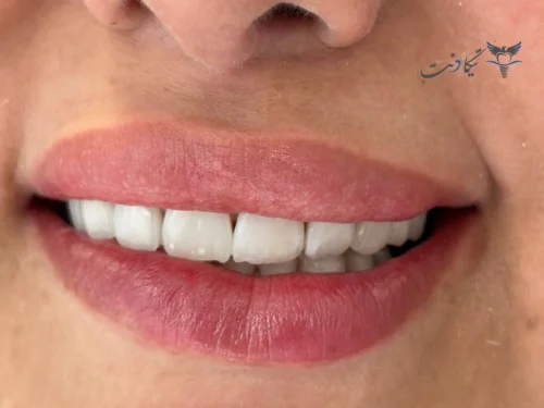 کامپوزیت سرامیکی در تهران