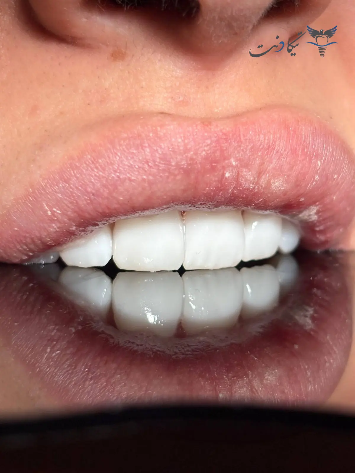 کامپوزیت سرامیکی