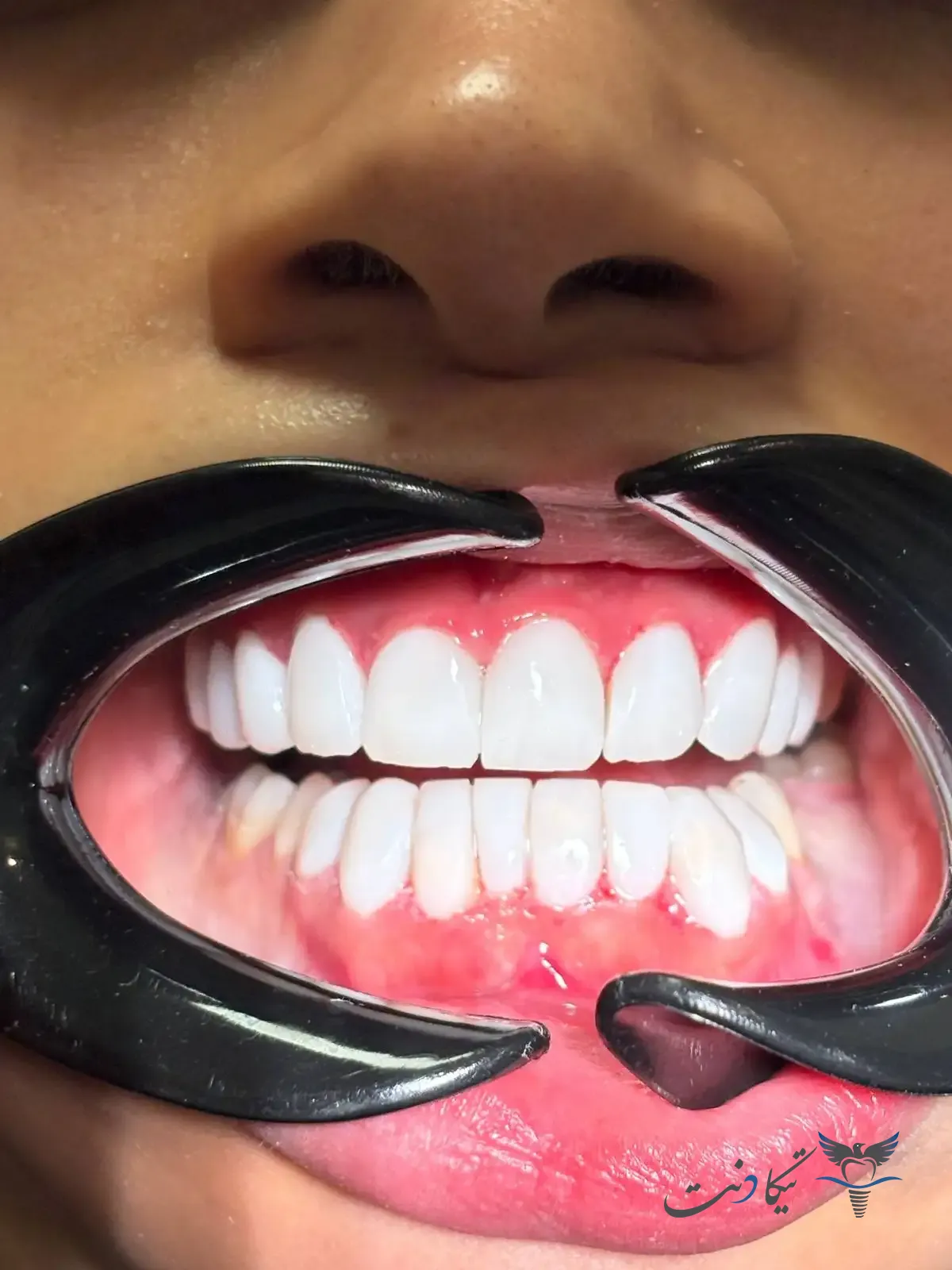 کامپوزیت قسطی در تهران