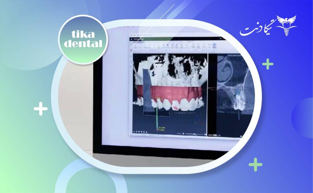 فرق ایمپلنت دیجیتال با معمولی
