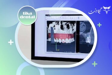 فرق ایمپلنت دیجیتال با معمولی