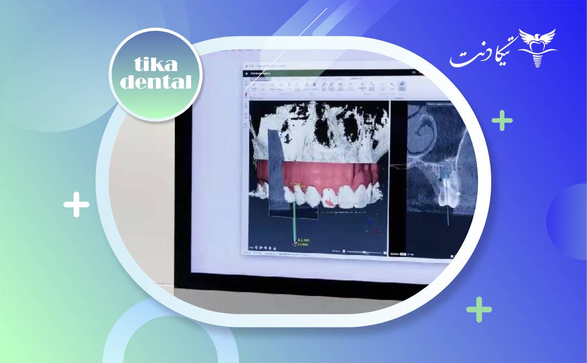 فرق ایمپلنت دیجیتال با معمولی