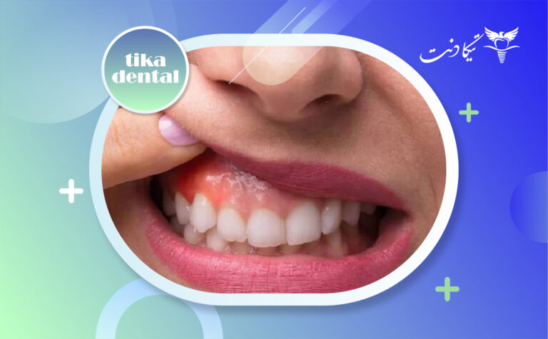 عوارض بلیچینگ دندان