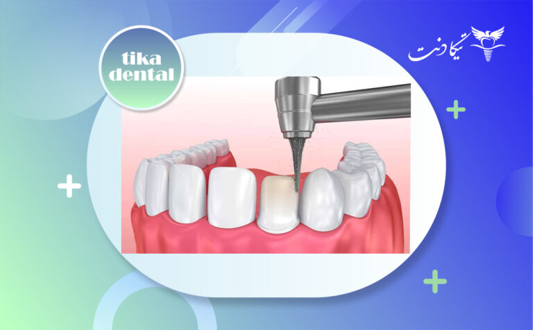 تراشیدن دندان برای کامپوزیت