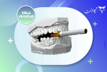 ایمپلنت برای افراد سیگاری