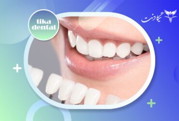 بهترین برند کامپوزیت دندان