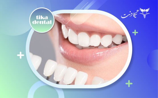 بهترین برند کامپوزیت دندان