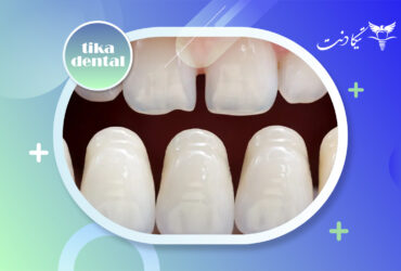 بهترین رنگ لمینت دندان