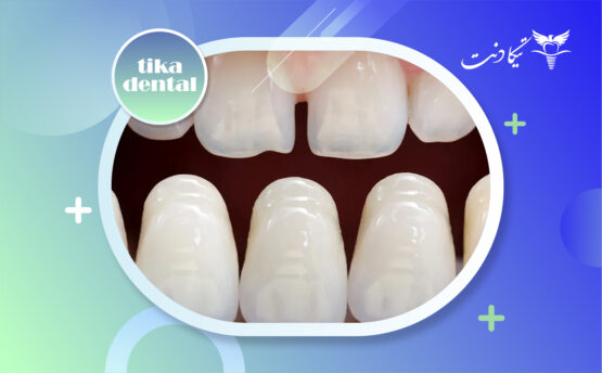 بهترین رنگ لمینت دندان