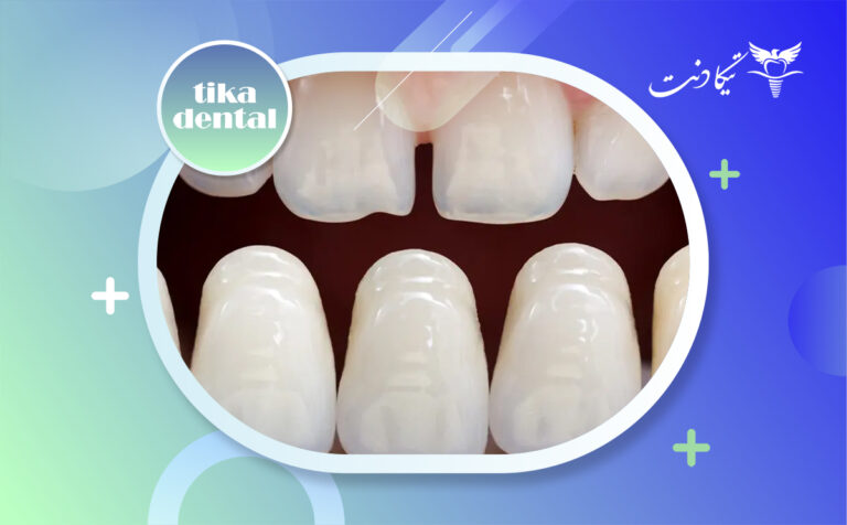 بهترین رنگ لمینت دندان