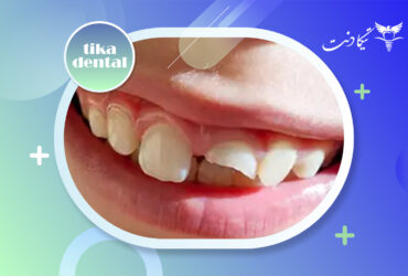 ترمیم دندان شیری